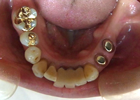 コーヌス義歯 術前